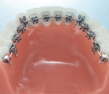 Orthodontie - Les bagues (multi-attaches)